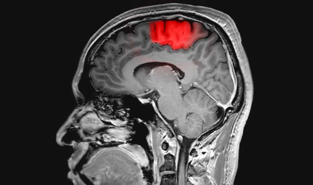 Brain scan