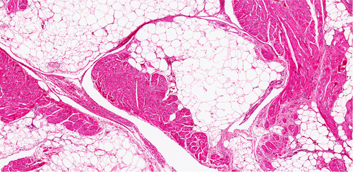Cardiomyopathy ReFlections Cardiomyopathy ReFlections
