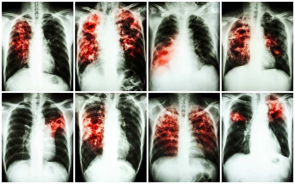 Respiratory1 Respiratory1