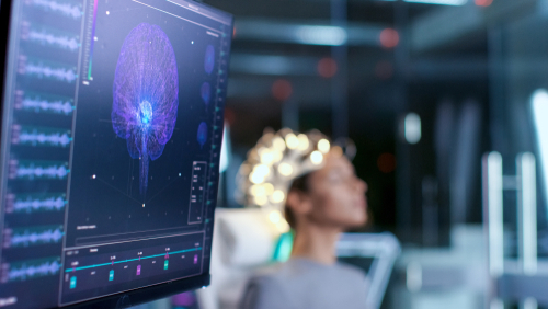 RGA Underwriting University II - Neurology RGA Underwriting University II - Neurology