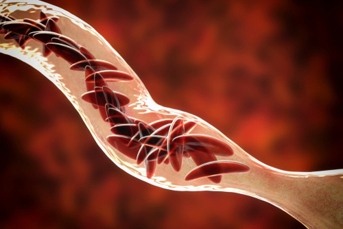 RGA U - Anemia RGA U - Anemia