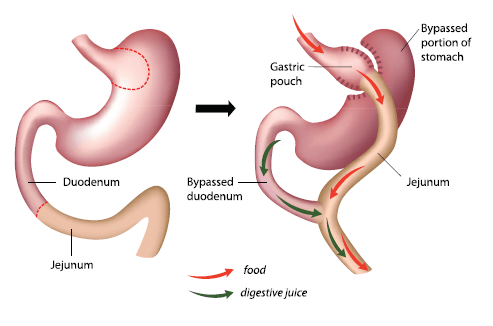 Illustration of Roux-en-Y gastric bypass surgery