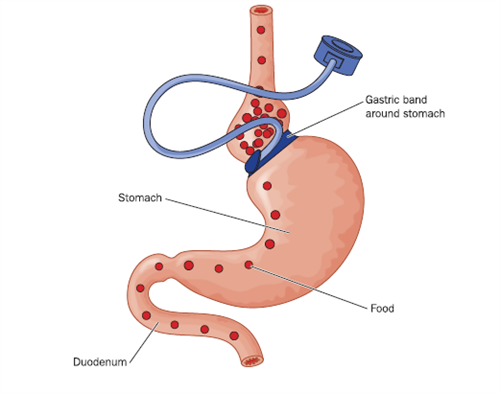 Illustration of Gastric (Lap) band surgery