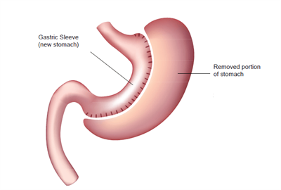 Illustration of Gastric sleeve / sleeve gastrectomy surgery