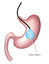 Bariatric_Schematic4