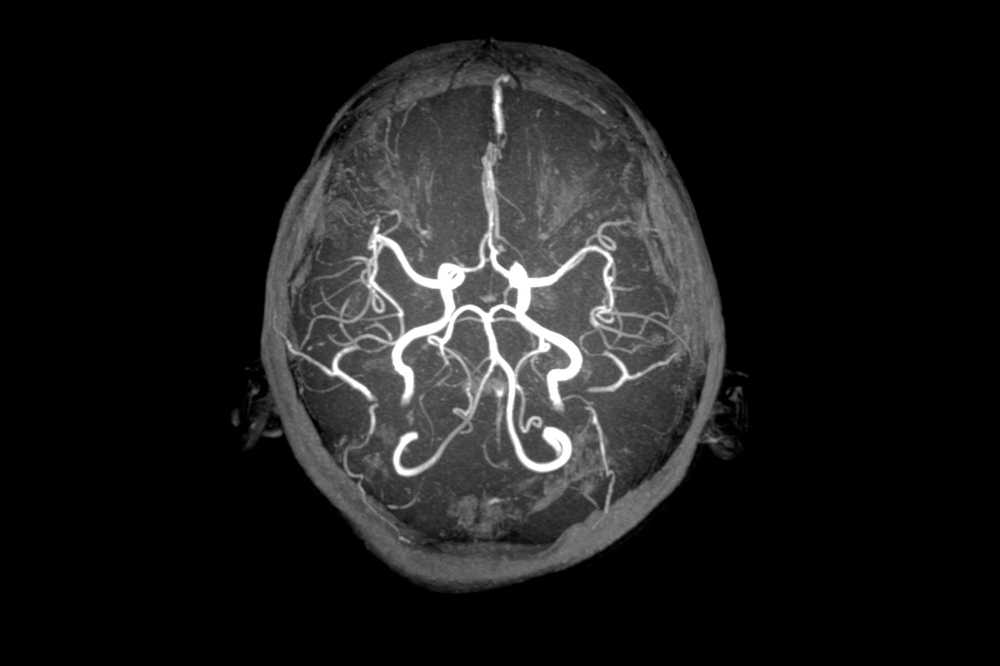 Cerebral Vascular Lesions