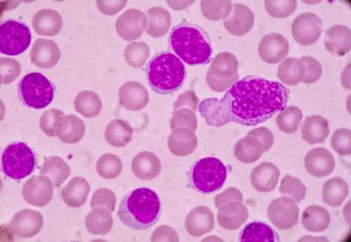 chronic lymphocytic leukemia