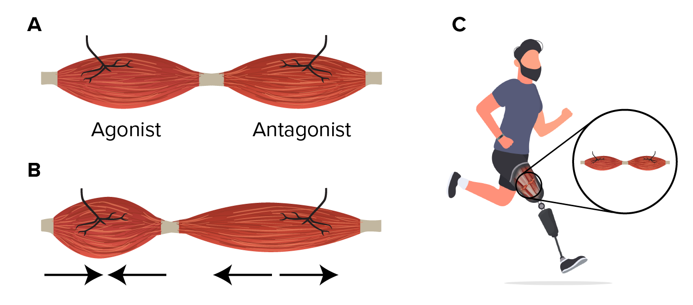 Figure 1-Agonist-antagonist myoneural interface