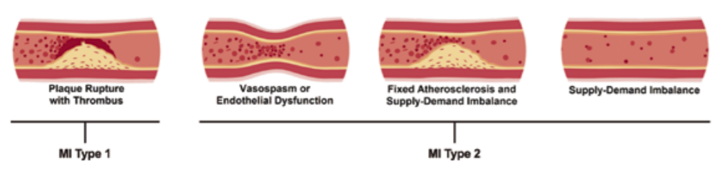 Figure 2, Myocardial