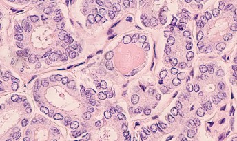 papillary thyroid carcinoma gross