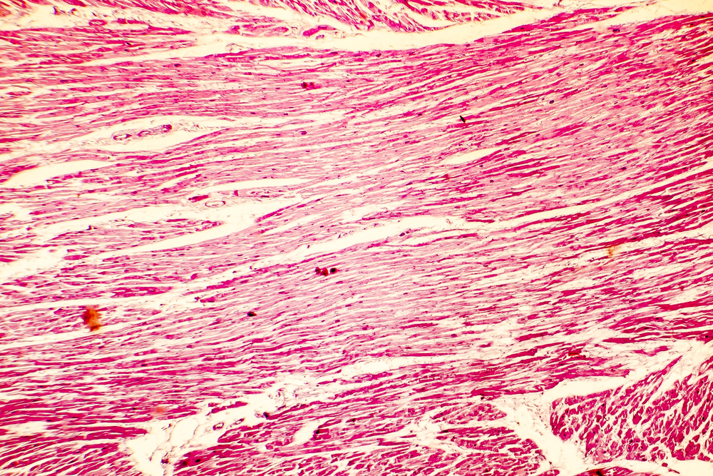 Microscopic image of Hypertrophic Cardiomyopathy