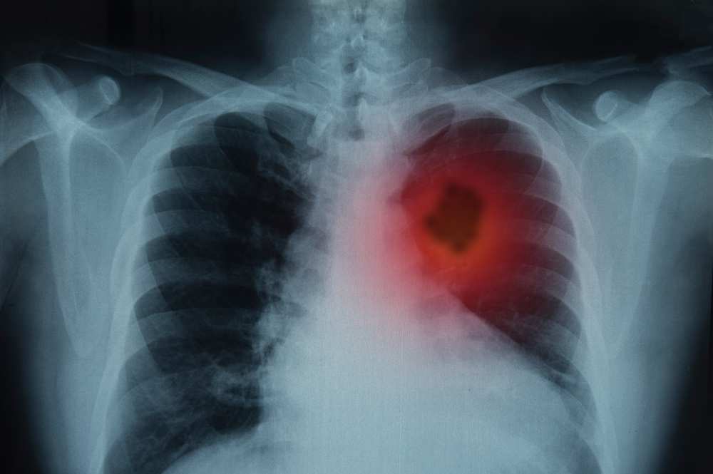 Lung_Cancer