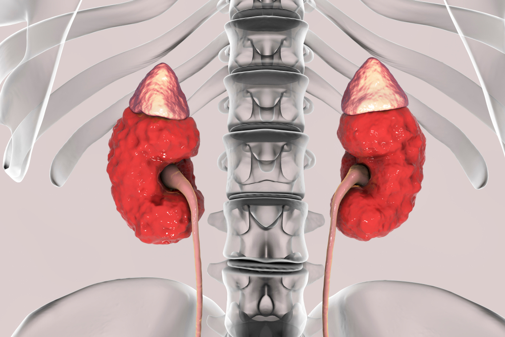 Kidney Disease