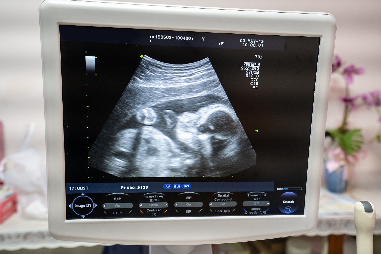 2D fetal ultrasound
