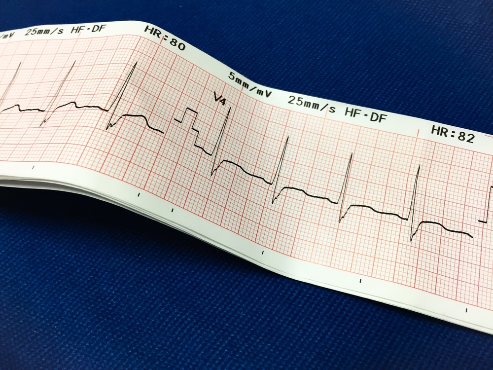 EKG Heart Disease