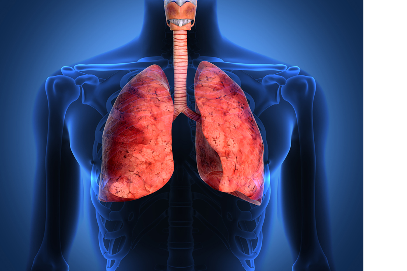 Illustration of lung cancer