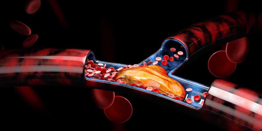 thrombosis graphic representation