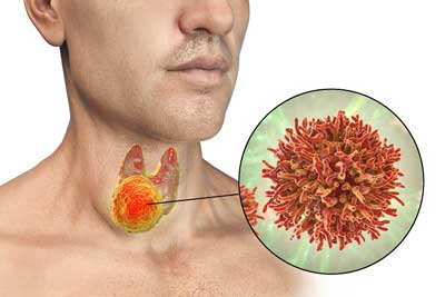 thyroid-cancer2