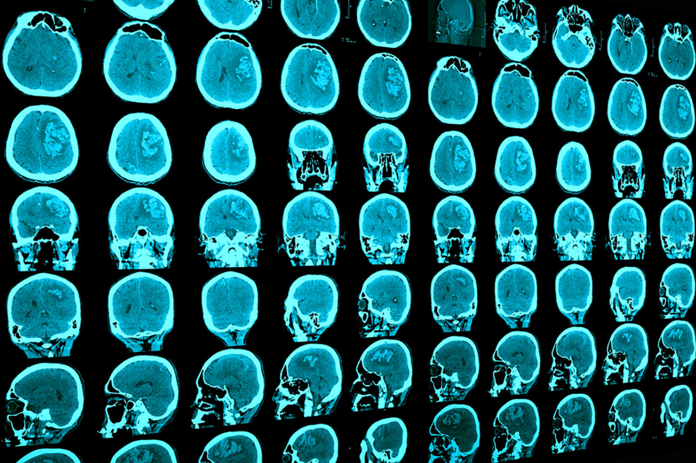 CT scan of a patient's brain