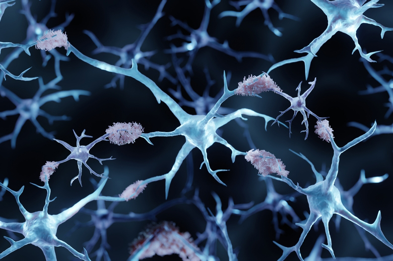 Alzheimer's disease, Amyloid plaques aggregates, 3d illustration